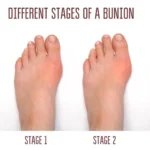 BUNION