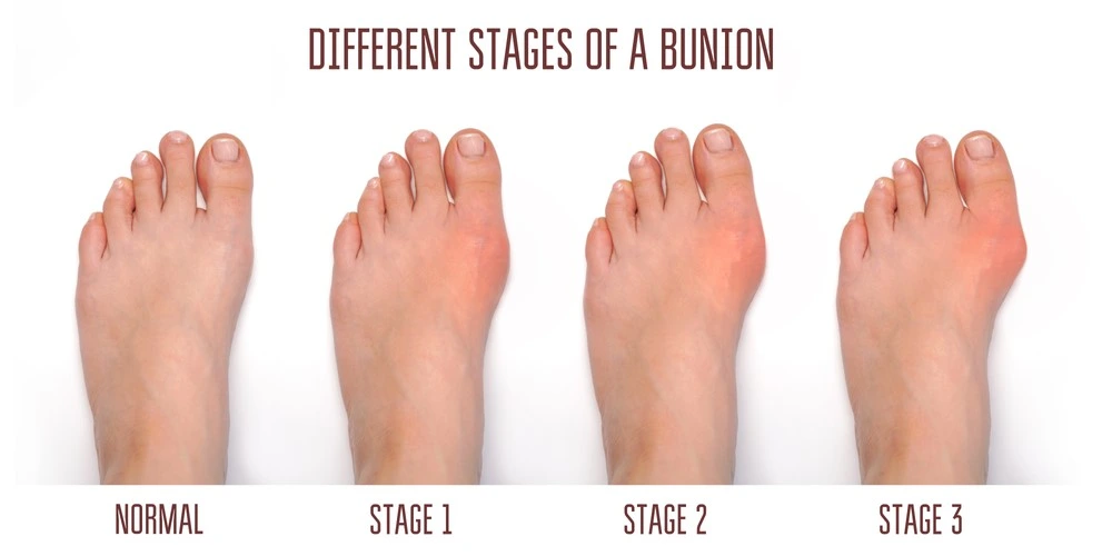 BUNION