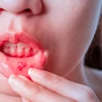 Mouth Ulcers