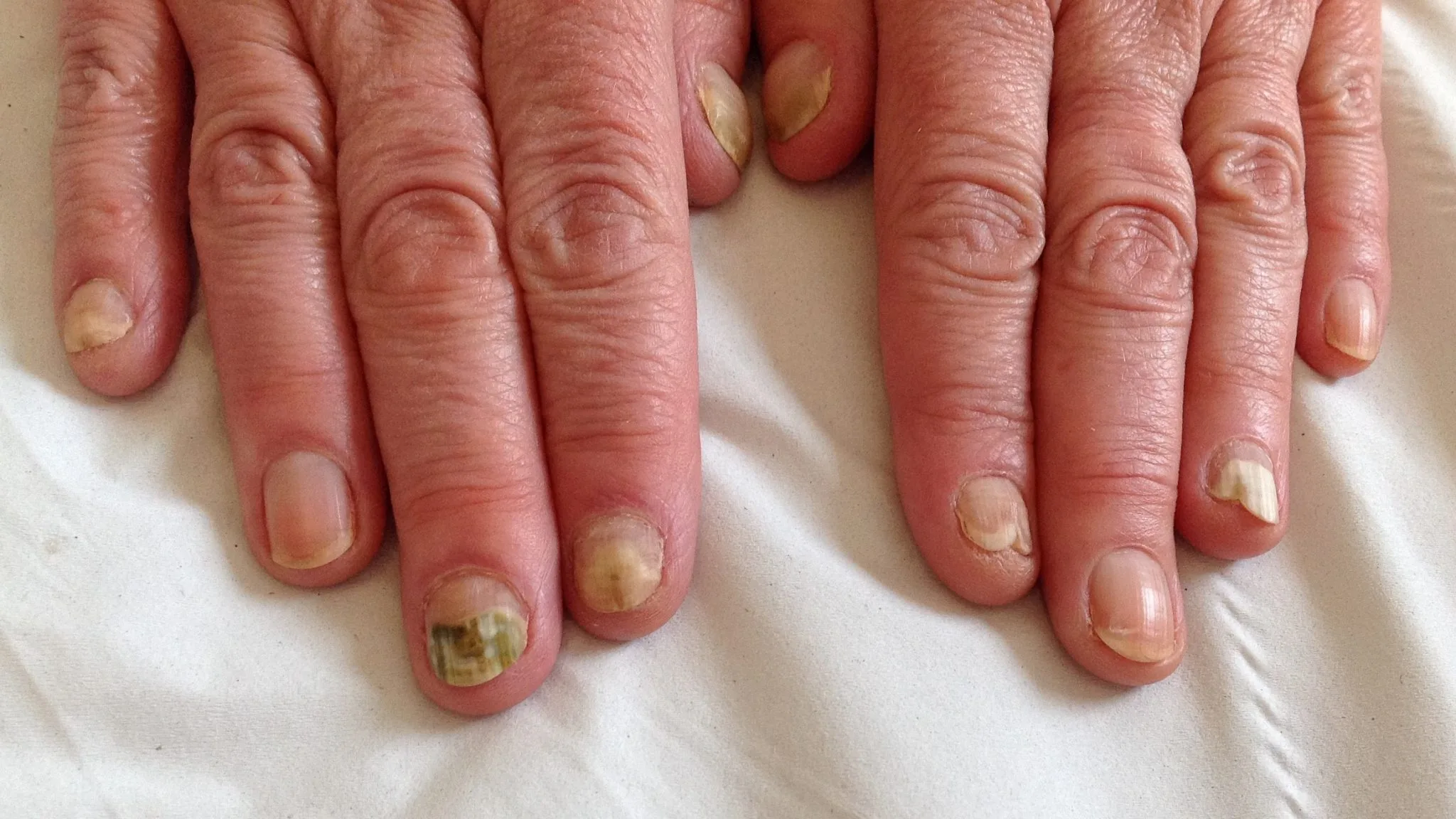 Nail fungus