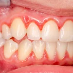 Periodontitis – Safeguard your Teeth