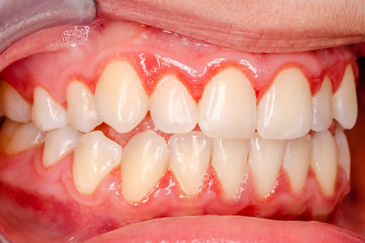 Periodontitis – Safeguard your Teeth