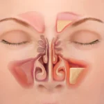 Learn about sinusitis