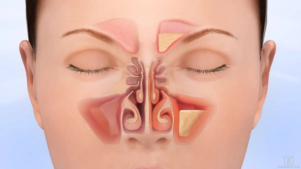 Learn about sinusitis