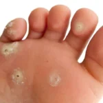 Plantar Warts