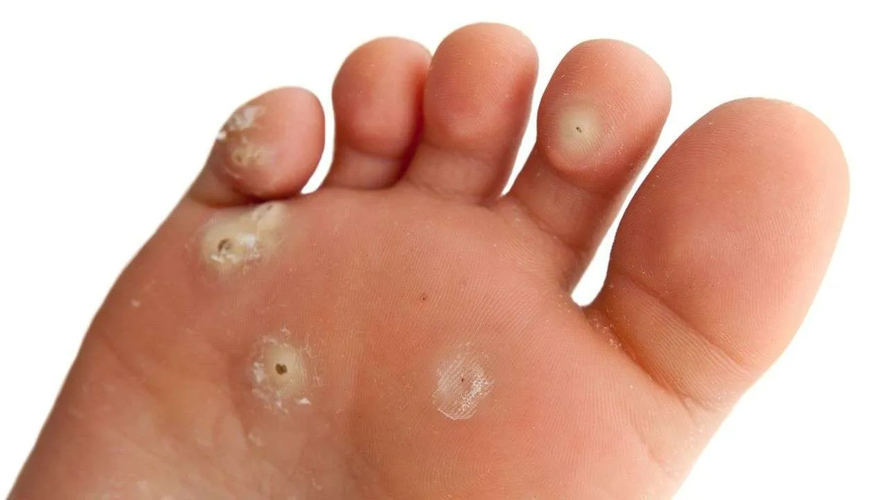 Plantar Warts
