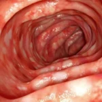 Ulcerative Colitis