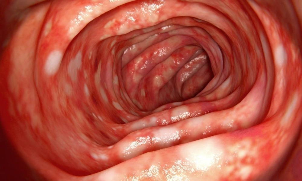 Ulcerative Colitis