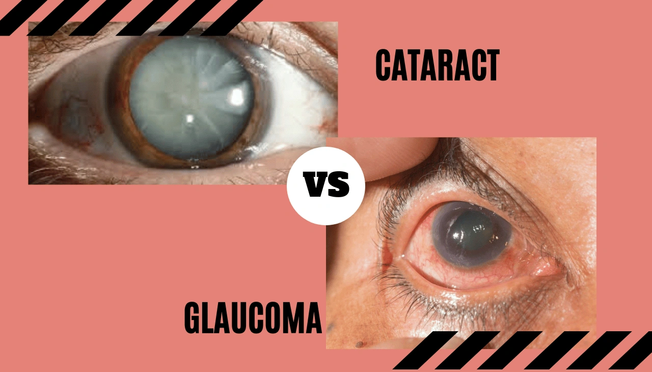 Glaucoma