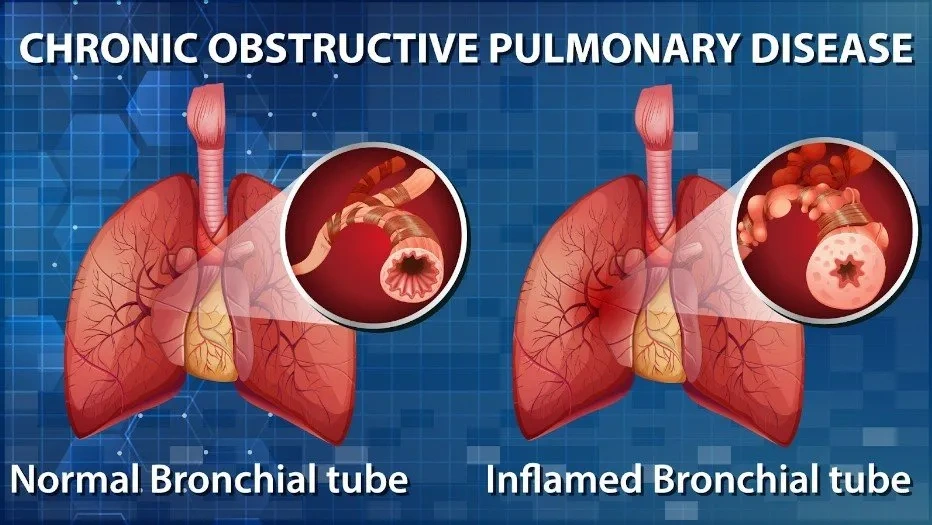 Chronic Obstructive Pulmonary Disease