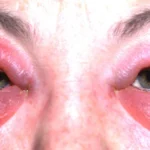 Conjunctivitis