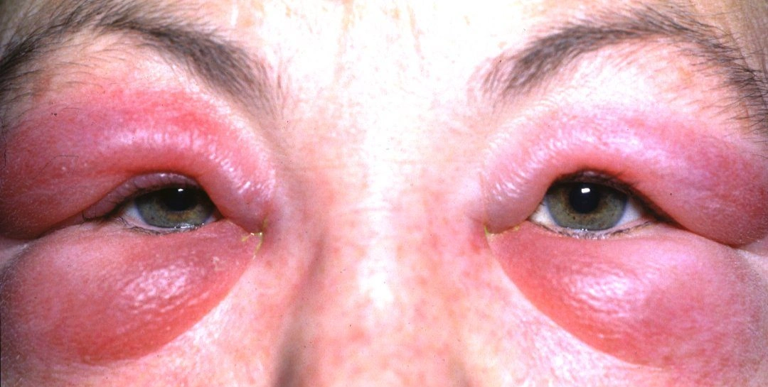 Conjunctivitis
