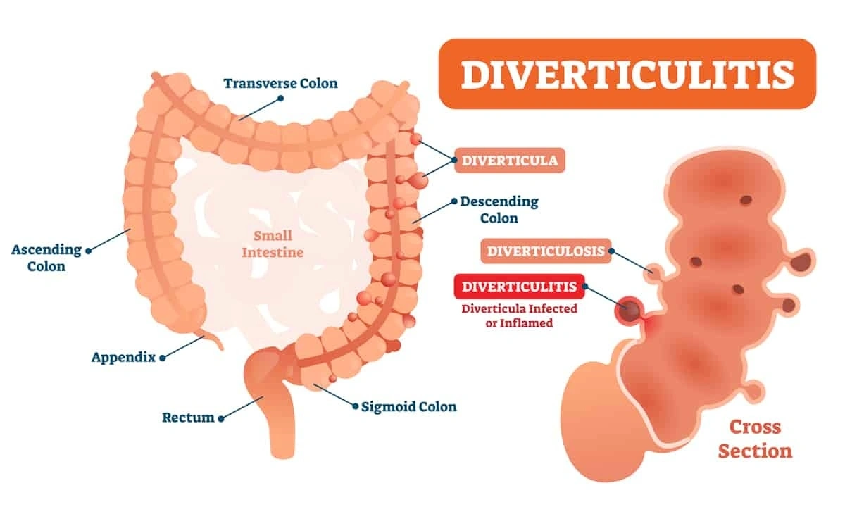 Diverticulitis