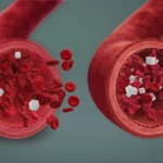 Diabetic Hypoglycemia