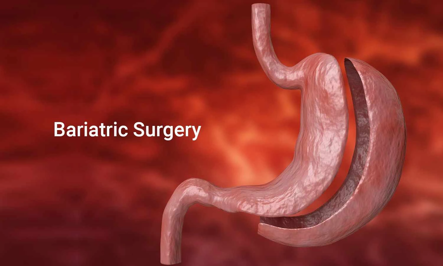 Bariatric Surgery