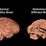 Alzheimer’s disease