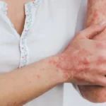 simple-and-effective-ways-to-control-psoriasis