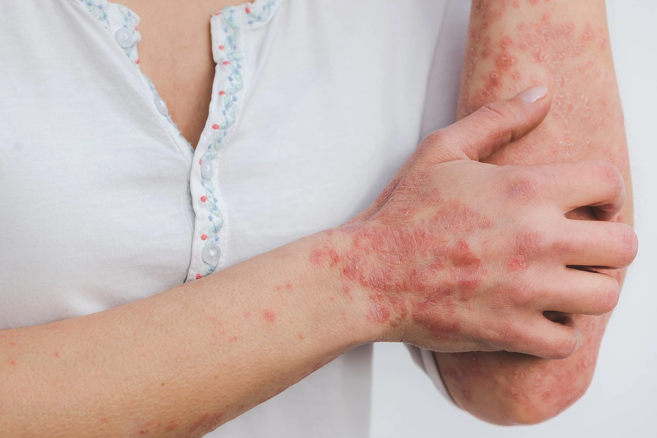simple-and-effective-ways-to-control-psoriasis