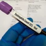 Absolute Eosinophil Count (AEC) Test