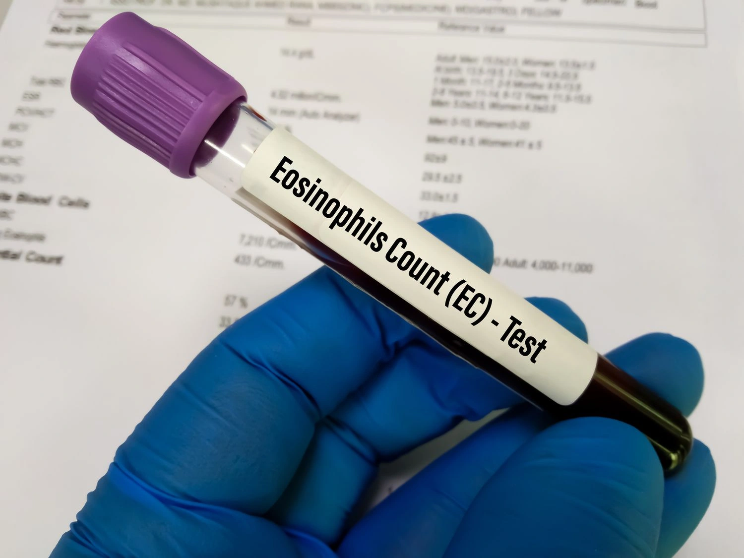 Absolute Eosinophil Count (AEC) Test