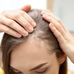 Alopecia (hair loss)