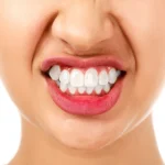 Bruxism (Teeth Grinding)