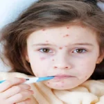 Chickenpox