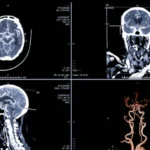 Angio Brain/Neck Test