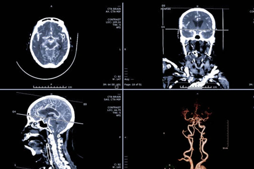 Angio Brain/Neck Test
