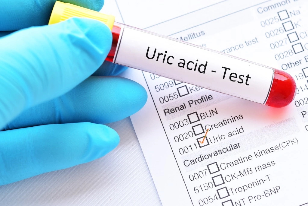 Uric acid Test