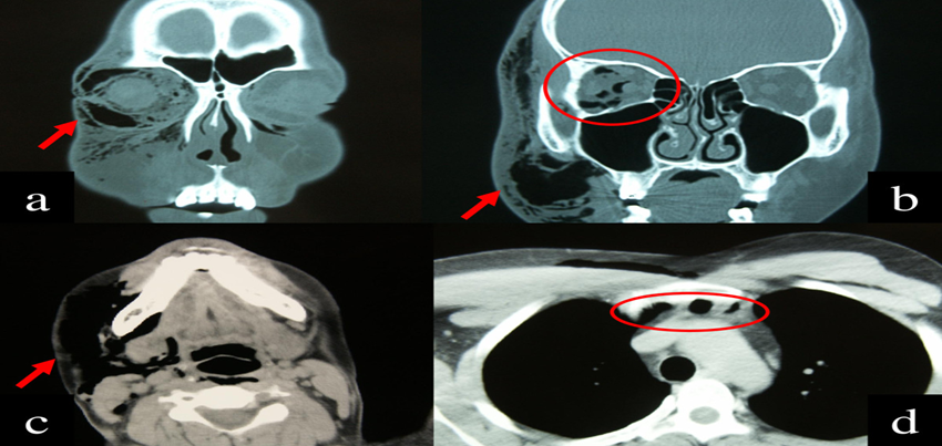 CT scan of the brain plain and orbit Test