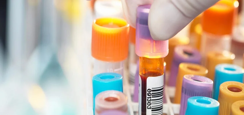 Partial Thromboplastin Time (PTT) Test