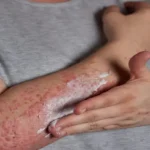 Psoriasis