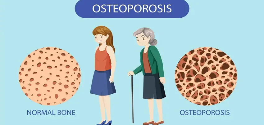 Osteoporosis