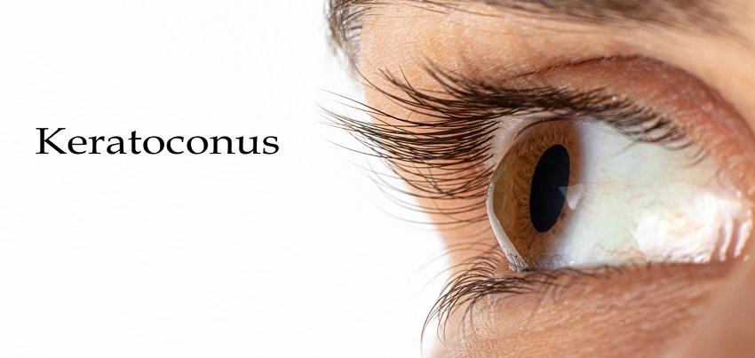 Keratoconus