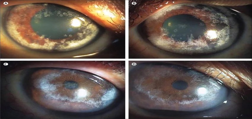Spheroidal Degeneration