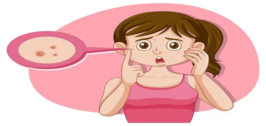 Keratosis Pilaris (KP)