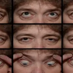 Abducens nerve palsy