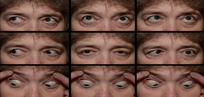 Abducens nerve palsy