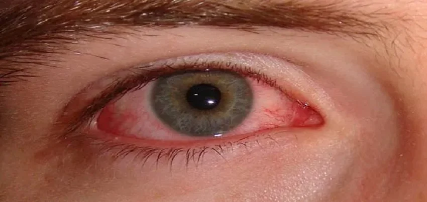 Adult inclusion conjunctivitis