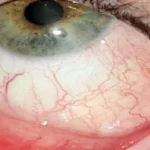 Atopic keratoconjunctivitis (AKC)