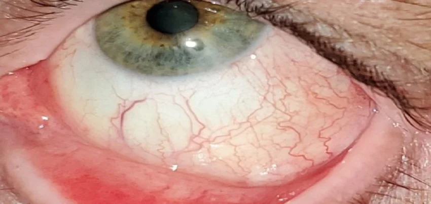 Atopic keratoconjunctivitis (AKC)