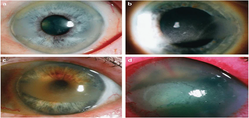 Band-shaped keratopathy