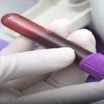 Blood-urea-Test