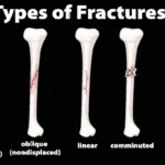 Bone fracture
