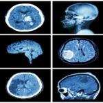 CT Scan Spiral Angio Brain
