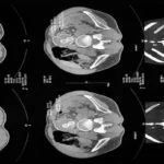 CT Scan Spiral Orbit