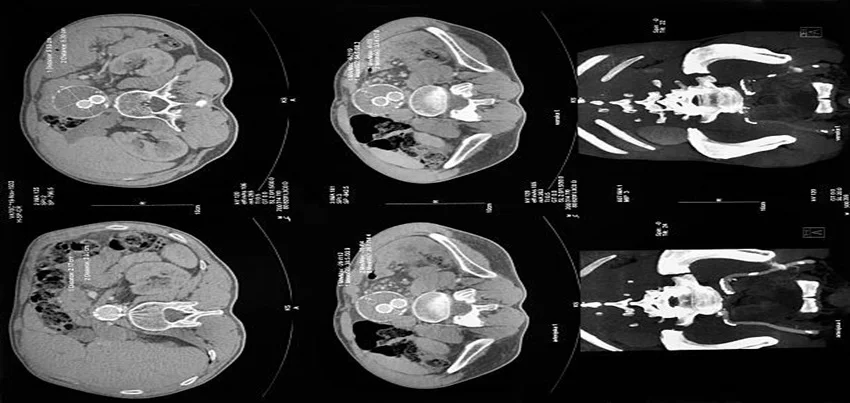 CT Scan Spiral Orbit