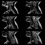 CT Scan Spiral Thoracic Spine