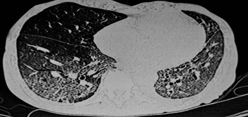 CT scan of the thorax